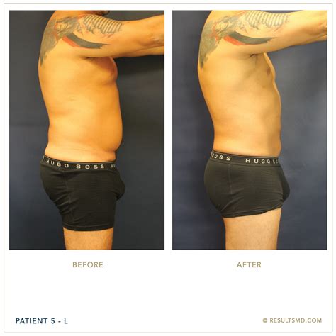 Male Liposuction in Miami, FL